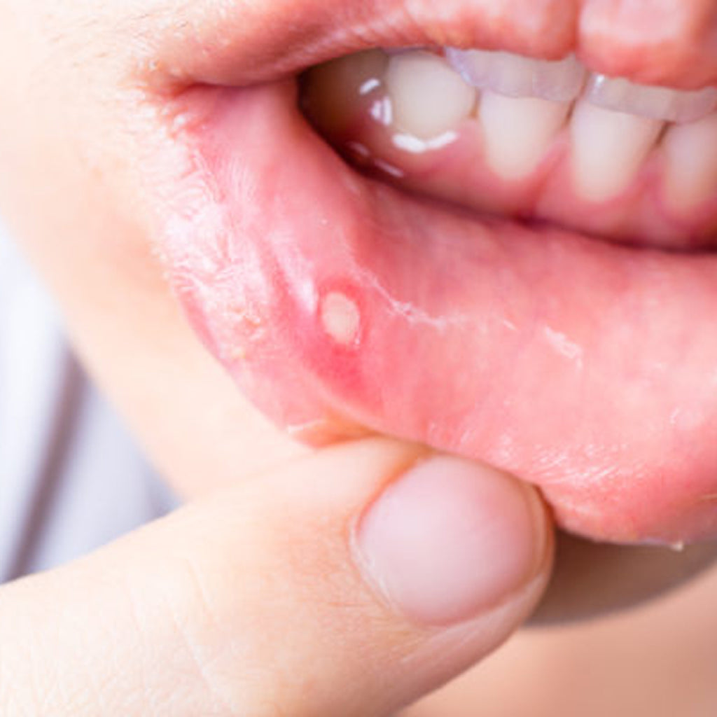 Calming Canker Sores